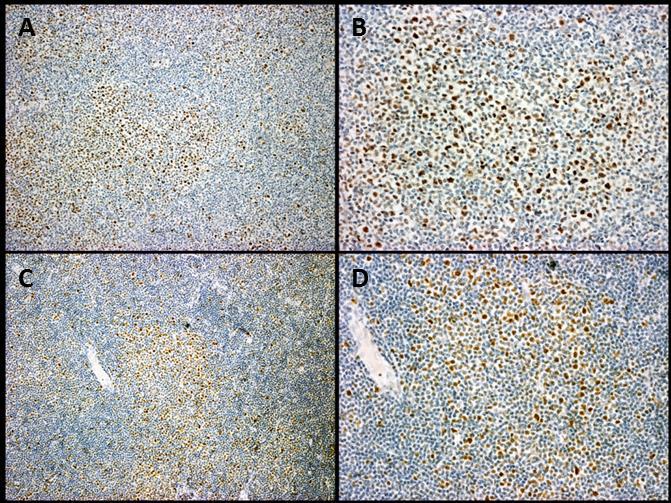 15 2.4 Epigenetikai vizsgálatok CLL-ben Az elmúlt 1-2 év az epigenetikai szemléletmód előretörését hozta a lymphomák területén, aminek során számos lymphoma entitásban írták le az epigenetikai