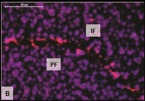 5 2. ábra: Lézerrel jelölt nyirokcsomói pseudofollicularis (PF) és interfollicularis (IF) területek reprezentatív FISH analízise. (A) Metilén-kék festés (x60). (B) 11q22.