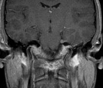 lágyrész felbontás: intracranial-, perineural terjedés, gerinc, fej-nyak, pelvis, abdomen, emlő, végtagok Szövet specifikus információ: zsír,