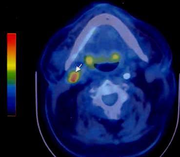 PET/CT általános indikációi Távoli szórás klinikai gyanúja Terápiás válasz kiértékelése Residuális tu?