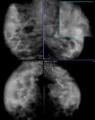 MAMMOGRAPHY Amennyiben az emlő denzitása