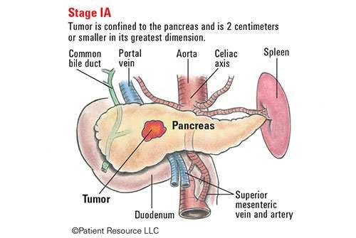 Pancreasrák:pTés pnkategóriák változtak pt1 2cm tumor pt1a 0,5cm tumor pt1b>0,5cm és 1cm tumor pt1c>1cm és 2cm pt2 >2cm és 4cm tumor pt3 >4cm tumor pt4