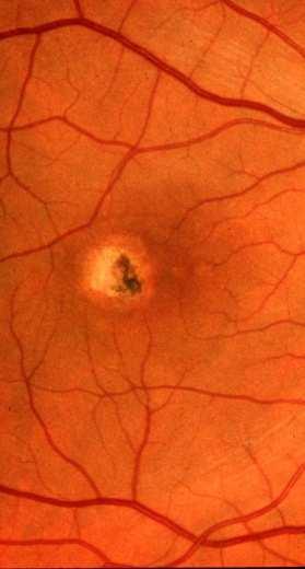 No vision improvement MPS: Macular Photocoagulation Study CAPT: