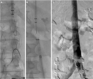 Cardiovasc Intervent Radiol (2016) 39:538 546 Percutaneous