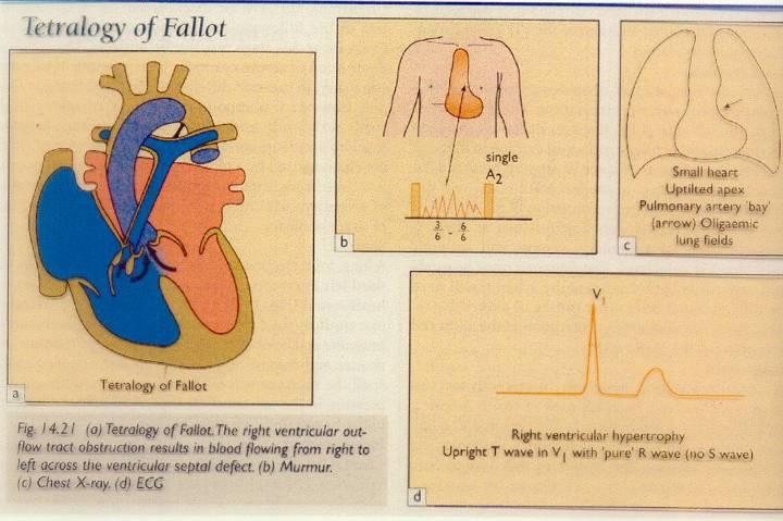 Fallot tetralógia Semmelweis