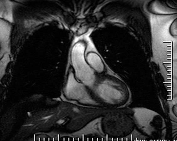 Phase Contrast Magnetic Resonance Aortic regurgitation PCMR