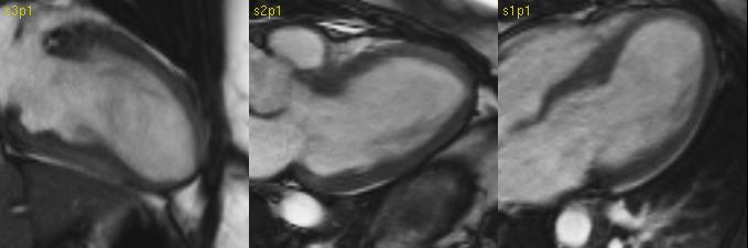 Normal coronary arteries; apical wall motion