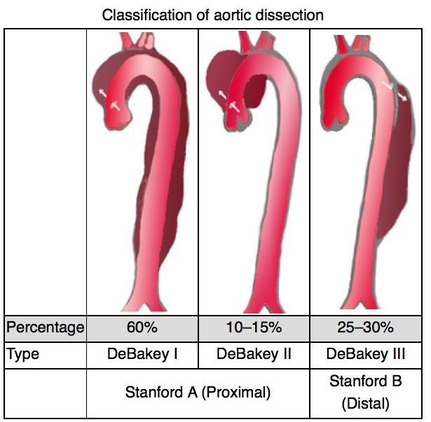 Aorta disscetio