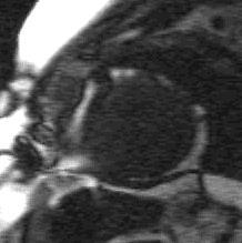 Contrast Injectio Infarceált