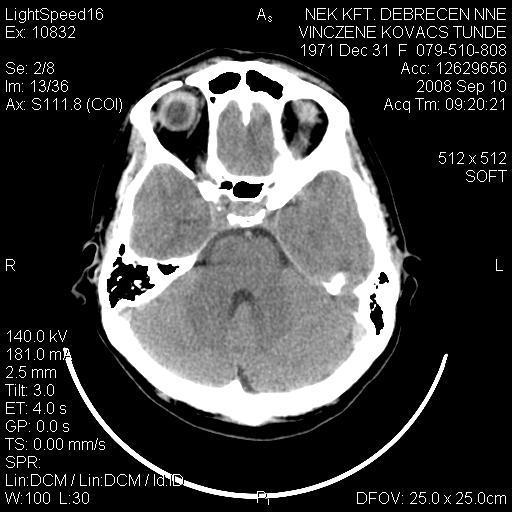 35 éves nő: CT vizsgálat a stroke után 1 óra 50