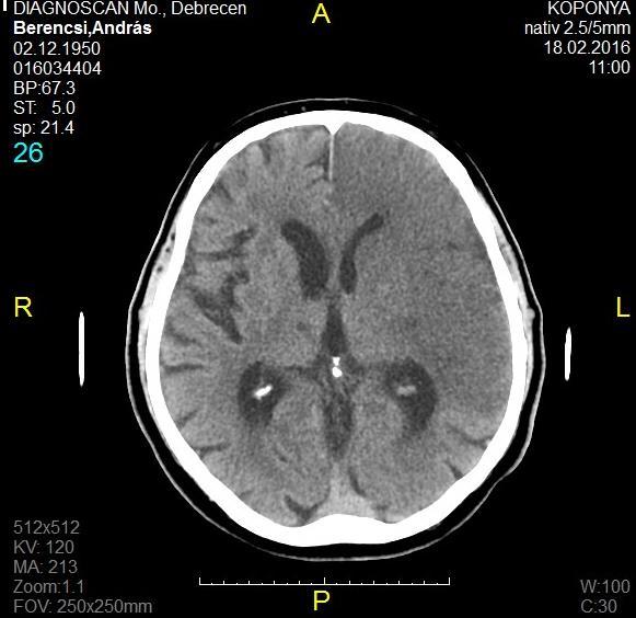 65 éves ffi., jobb oldali fv.tag plegia, av.tag csonkban flexio, globalis aphasia.