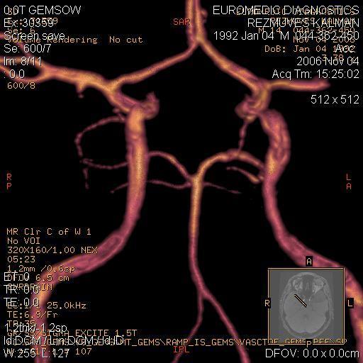 Stroke kezdete: >5 órája. MRI és MRA IA.