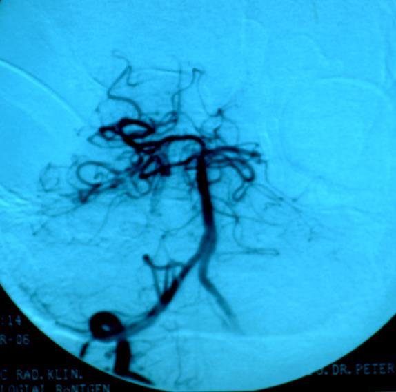 Thrombolysis.