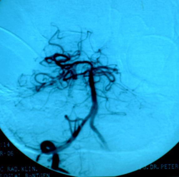 Thrombolysis.