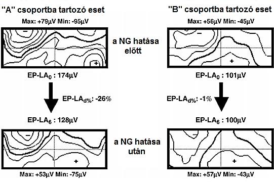 58. ábra. Az összesített bal pitvari elektromos potenciál (EP-LA) és ennek százalékos változása (EP-LA d% ) a sublinguális nitroglicerin adását követő 6.