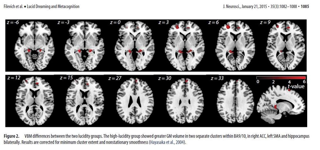 Tudatos álmodás mint képesség: agyi korrelátumok Eltérések a prefrontális kérek szürkeállományának relatív térfogatában.