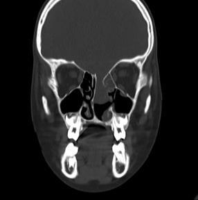 ábra: coronalis CT felvétel FESS műtét után [19] Encephalocele resectio és dura plastica történt.