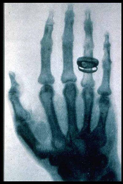 Röntgensugárzás az orvostudományban. Röntgen kép és Komputer tomográf (CT)  - PDF Free Download