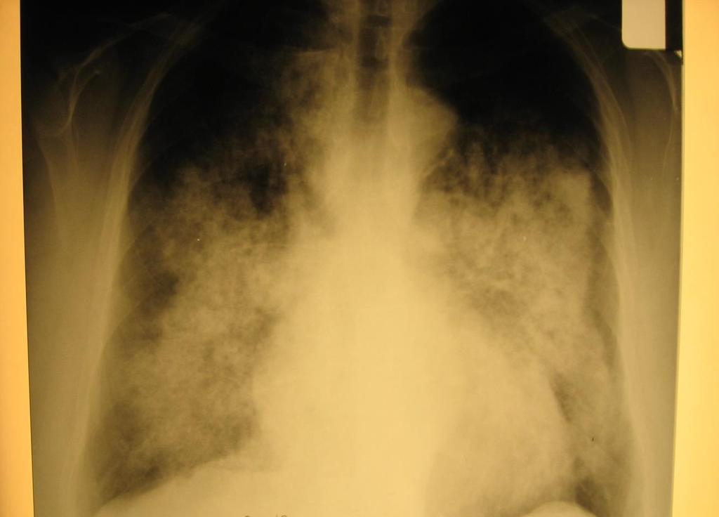 Életveszélyes komplikációk Tüdővérzés