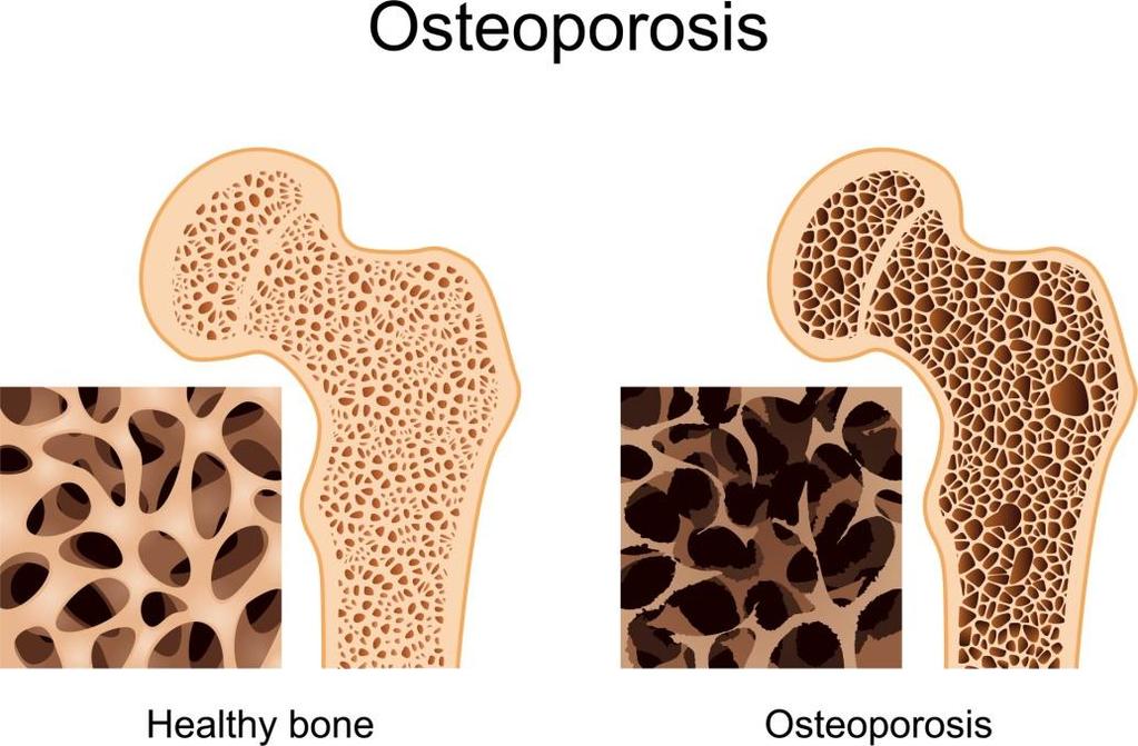 Osteoporosis A csontgerendák sorvadása miatt a velőűrök kitágulnak, megnagyobbodnak.