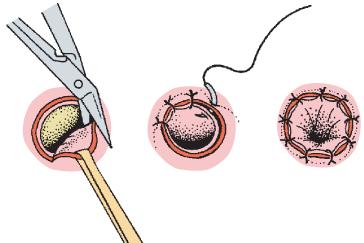 Cystostomia (Partsch I.