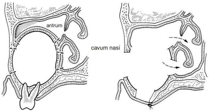 Antralis cystostomia Kiterjedt cystákat a maxillában az orr- vagy arcüreg melléküregévé alakítjuk Érzéstelenítés, lebenyképzés Hámbélés teljes vagy részleges eltávolítása Érintett fogak ellátása
