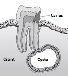Állcsontcysták: a) Odontogén cysták b) Non-odontogén (fissuralis) cysták c) Pseudocysták Elhelyezkedés szerint: a) Csontcysták b) Lágyrészcysták Kialakulás szerint: a) Gyulladásos eredetűek b)