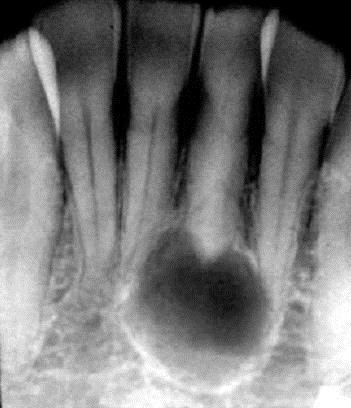 , Mesgarzadeh A. H., Moradzadeh Khiavi M.: Mandibular Fracture Associated with a Dentigerous Cyst: Report of a Case and Literature Review.