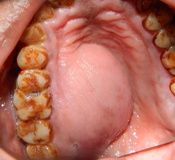 Sebészi kezelésük lehetőségei Cystectomia (Partsch II.): a) Intraoralis megközelítésből b) Extraoralis megközelítésből Cystostomia (Partsch I.