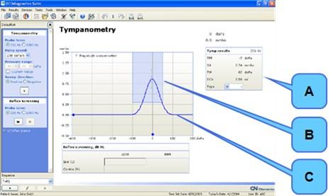 14 Diagnosztikai timpanometria A diagnosztikai timpanometria eredménye OTOsuite Automatikus skála (Auto Scale) (timpanogram) Az automatikus skálázás dinamikusan változtatja a nézetet az aktuálisan