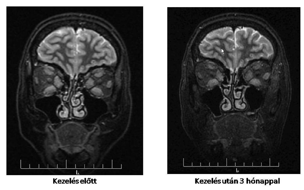 Az orbita MR-rel meghatározott átlag T2 relaxációs idő (n=40 külső szemizomban mérve) a kezelés előtt 96.91±17.61 ms volt, mely az egy éves kontrollra 84.29±9.41 ms-ra csökkent (t-test, p<0.001).