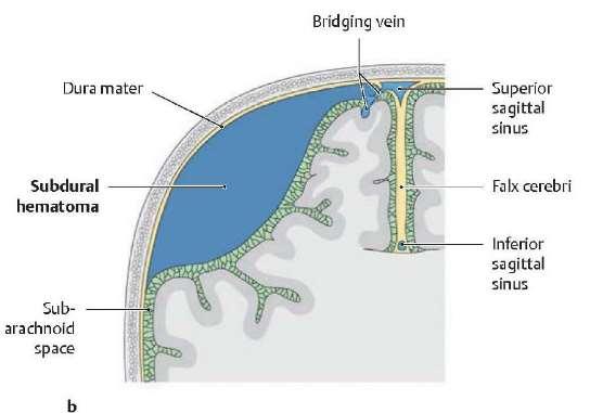 Subduralis- venás https://www.