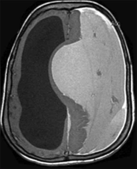 Giant unusual shaped chronic subdural hematoma in