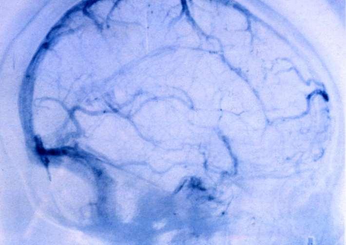 Carotis angiográfia vénás fázisa Vena superior cerebri Sinus sagittalis