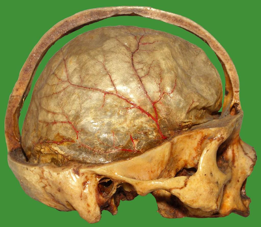 Dura mater cranialis (kissé zsugorodott preparátum; a dura itt elvált a csontoktól in vivo a dura szorosan a csonthártyához tapad és nincs