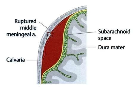 1. Epiduralis hematoma 2.