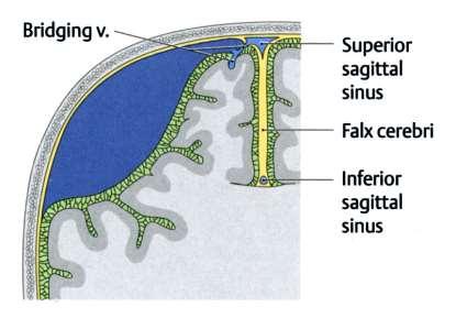 Subarachnoidalis vérzés: megrepedt