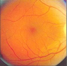 Diabeteses maculopathia n Enyhe Kis fokú retina vastagodás, vagy kemény exsudatumok