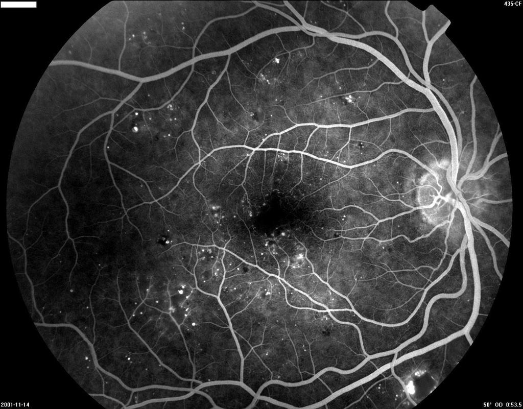 diabeteses retinopathia diagnosztika