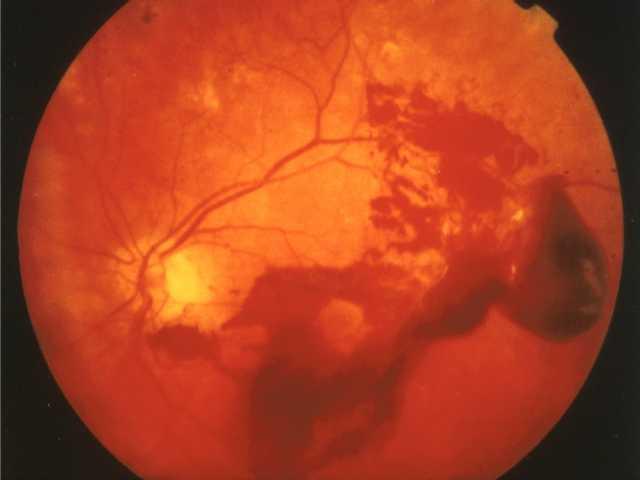 Proliferatív retinopathia n Üvegtesti