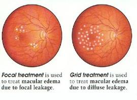 A diabeteses macula oedema kezelése n Fokális lézerkezelés n Grid