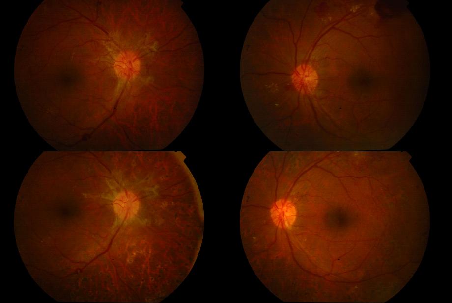 diabeteses retinopathia diagnosztika
