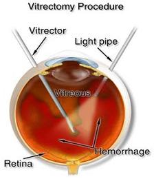 Diabéteszes retinopathiát diagnosztizáló szoftver