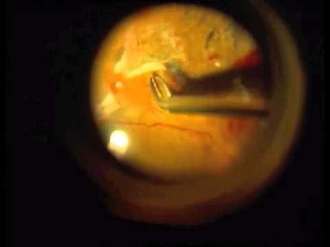 diabeteses retinopathia kezelése