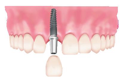 16 CORTICON Implant System CORTICON alkalmazási területei Egy fog hiány esetén Ilyenkor egy fog pótlásához nem kell