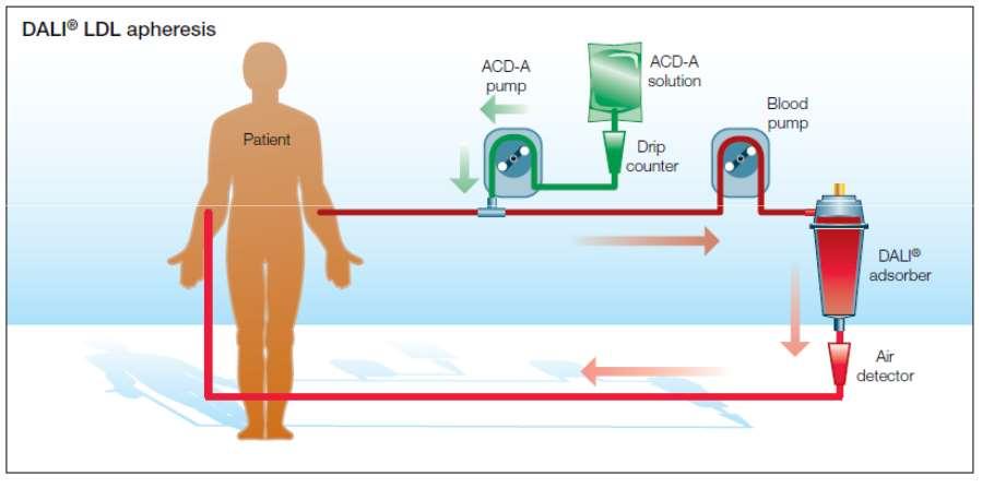 LDL aferezis (DALI) DALI = Direct Adsorption of Lipoproteins Plazma szeparáció nélkül,