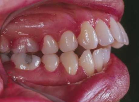 A direkt mechanikai parodontális sérüléseket leszámítva a gingivitis és parodontitis elsődleges etiológiai tényezője a