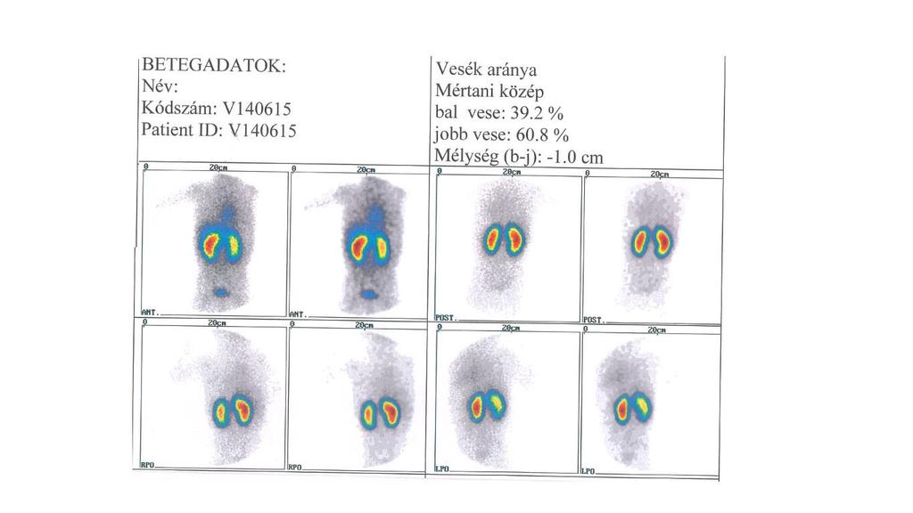 5. ESETTANULMÁNYOK 1. 2 éves leánygyermek a vese veleszületett rendellenessége gyanújával érkezett DMSA vizsgálatra. Anamnézisében szerepel, hogy már intrauterin észleltek veseüregrendszeri tágulatot.