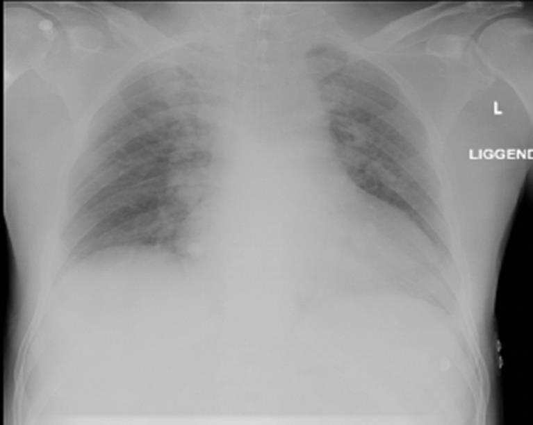 Hipoxia okai, gépi lélegeztetés célja Aspiráció Tüdőödéma PTX Tüdőkontúzió Pneumonia Atelektázia NPO (Neurogen pulm.