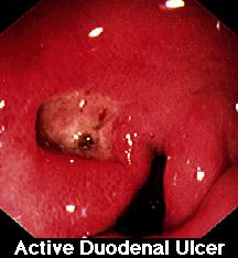 Helicobacter pylori Acut gastritis Krónikus